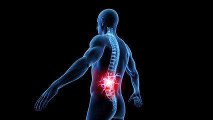 3d medical illustration of lower back pain - 596363494
