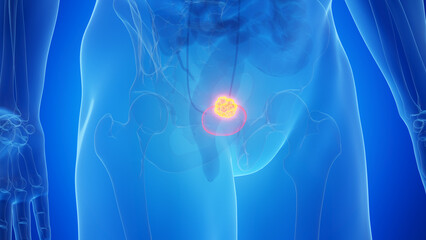 3D Rendered Medical Illustration of Urinary Bladder Cancer.