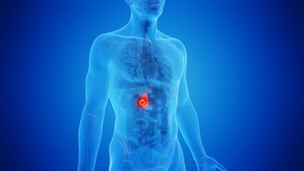 3D rendered Medical Illustration of Male Anatomy - gallbladder Cancer.