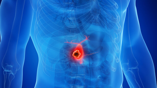 3D rendered Medical Illustration of Male Anatomy - gallbladder Cancer.
