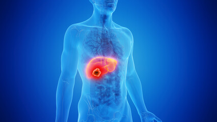 3D Rendered Medical Illustration of Male Anatomy - liver cancer - 596365018