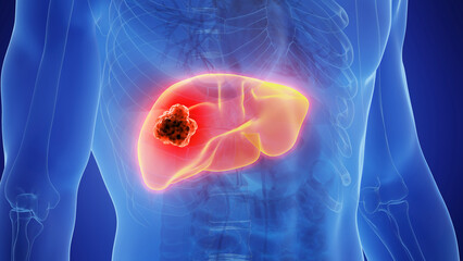3D Rendered Medical Illustration of Male Anatomy - liver cancer