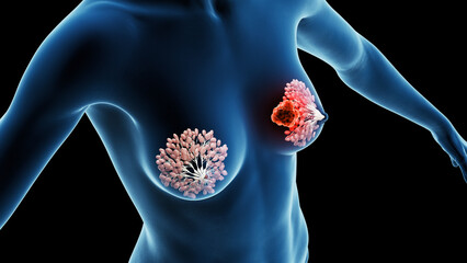 3d rendered medical illustration of breast cancer - 596368487