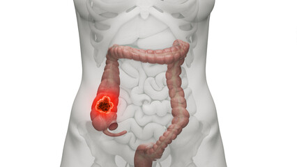 3d illustration of colon cancer