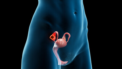 3d medical illustration of ovarian cancer - 596369602