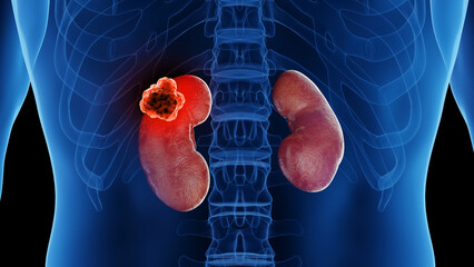 3d rendered medical illustration of kidney cancer - 596374480