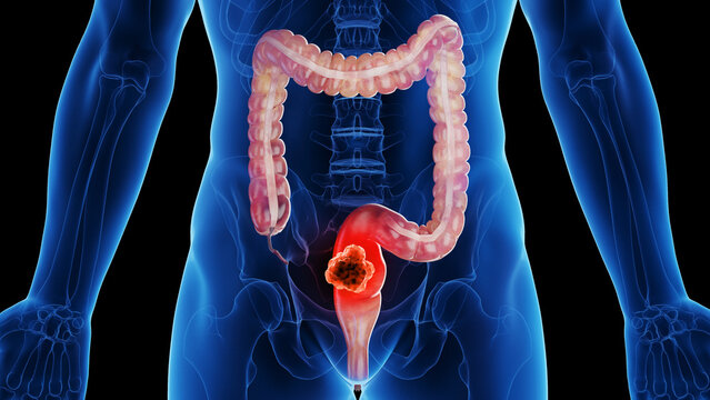 3d rendered medical illustration of rectal cancer