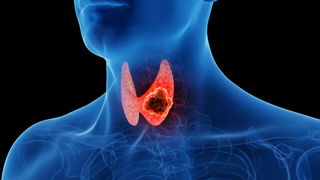 3d rendered medical illustration of thyroid cancer