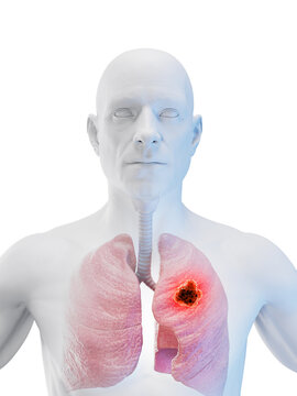 3d rendered medical illustration of lung cancer