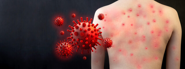 MONKEYPOX. Human skin is covered with blisters from monkeypox. Virus, epidemic, disease. Mockup of a dangerous, flying virus, bacterium, microbe.Black background.