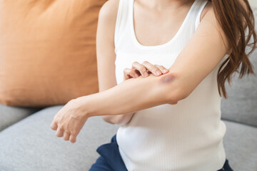 Close up of stain bruise wound on arm, contusion asian young woman, girl an accident fell down stairs, hand on elbow in healing injury by massage hematoma blood. Extravasation blue, purple on skin.
