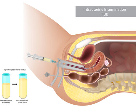 Schematic illustration artificial insemination. Intrauterine insemination IUI. Sperm injected into uterus