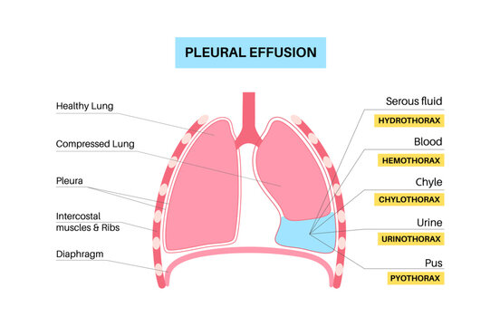 Pleural effusion poster