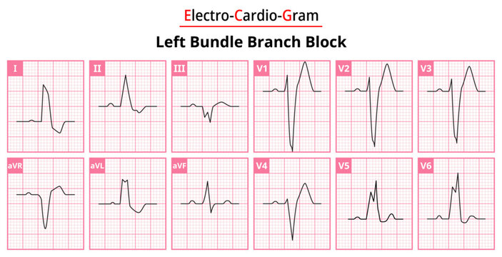 Left Bundle Branch Block - The Differences in ECG Waveform for Each of the 12 Leads - Medical Vector and Illustration