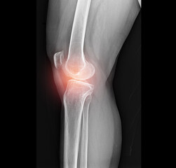 Fototapeta premium Inflamed knee joints, pain, x-ray images