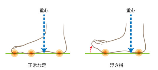 正常な足の重心と、浮き指の足の重心