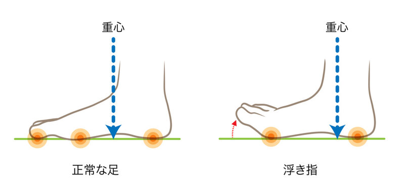 正常な足の重心と、浮き指の足の重心