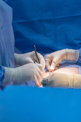 Team of doctor and surgeon or nurse did appendectomy surgery inside operating room in hospital.People in blue uniform with dramatic dark background.Medical team with glove and instrument.