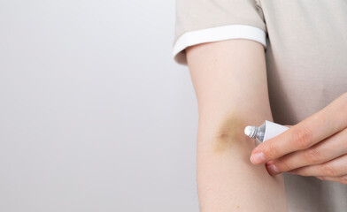 Someone Applies Healing Cream, Ointment On Hematoma, Bruise After Injection, Blood Sampling From...