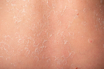 Sunburn, close-up of human skin. Flaky skin from allergies, peeling or eczema. Dry skin in need of treatment and hydration.