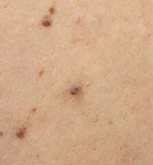 mole on the body as a background