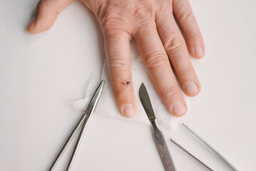 Removal of suture on finger of patient in clinic. Inspection of seam on finger after removal of...