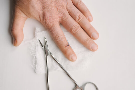 Dermatofibroma bilder Bläddra bland 103 stockfoton, vektorer och