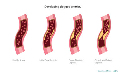 Cholesterol deposits (plaques) in the heart arteries and inflammation are usually the cause of coronary artery disease. Artery blockage vector illustrations.