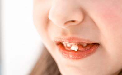 Charming smiling little girl kid with opened mouth shows staggering loose falling out first baby...