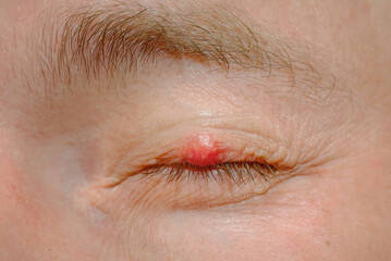 Eyelid sickness. Demodicosis mite diseas, demodex. Chalazion on eyelid. Eye disease and treatment. Inflammation of eyelashes hair follicle, Demodex folliculitis. Scales on skin and eyelashes, eczema