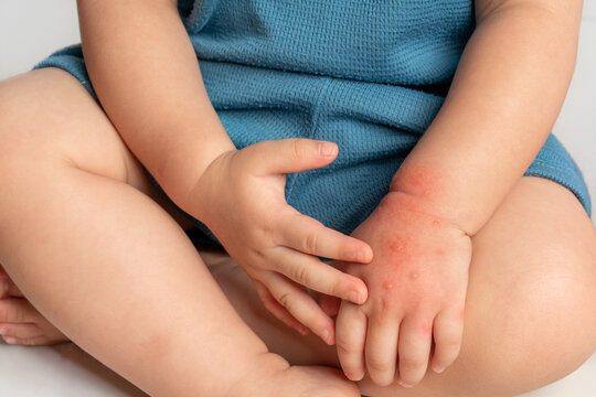 Asian baby have red swollen and blister on hand caused by insect bite, on white background.
