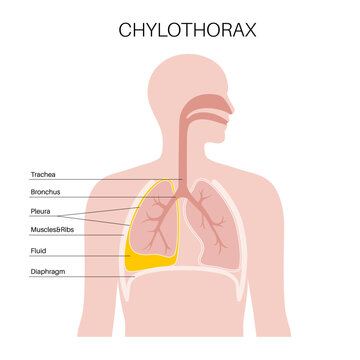 Chylothorax anatomical poster