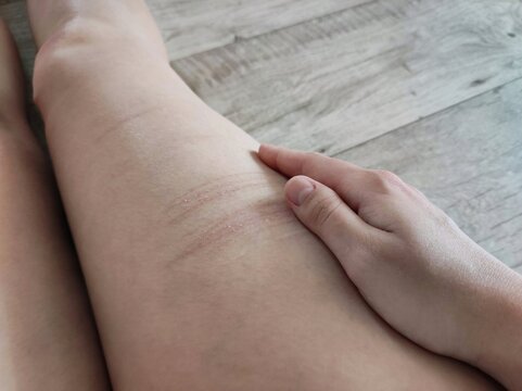 leg with traces of scars after self-harm, the concept of psychology and autoaggression