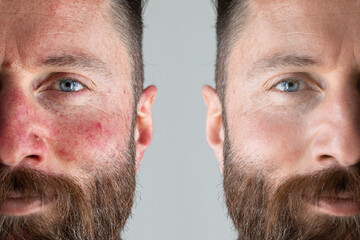 Before and after a rosacea laser treatment - obrazy, fototapety, plakaty