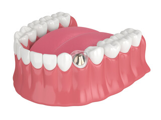 3d render of lower jaw with cast post and core tooth restoration