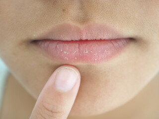 A girl's mouth is cracked and flaky. Caused by less drinking water, wind and cold air. lip care...