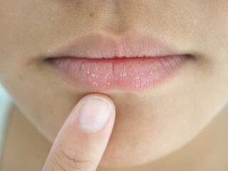 A girl's mouth is cracked and flaky. Caused by less drinking water, wind and cold air. lip care concept. closeup photo, blurred.