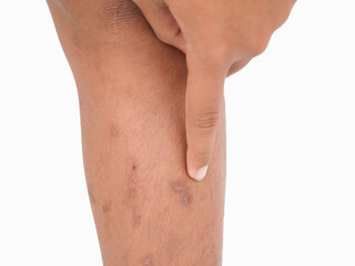 Asian boy has allergies with mosquitoes bite. Many mosquito bites hurt and scars on the legs....