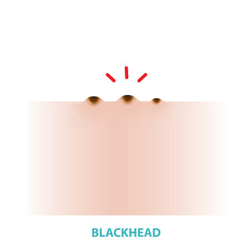 Blackhead acne vector isolated on white background. Formation of comedone, blackhead, a plug of sebum in a hair follicle, darkened by oxidation on the skin. Flat design vector acne illustration.