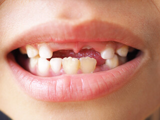 Fototapeta premium Young boy lost her first bottom front milk teeth and upper front teeth. Childhood health care concept. Closeup photo, blurred.