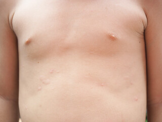Asian kid's body rash is caused by urticaria, food allergies, insect bites. health concept. Closeup...