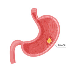 Stomach cancer. Malignant cancerous tumor. Anatomical vector illustration isolated white background cartoon style