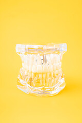 The Human jaw or Acrylic dentures model with implants on yellow background.
