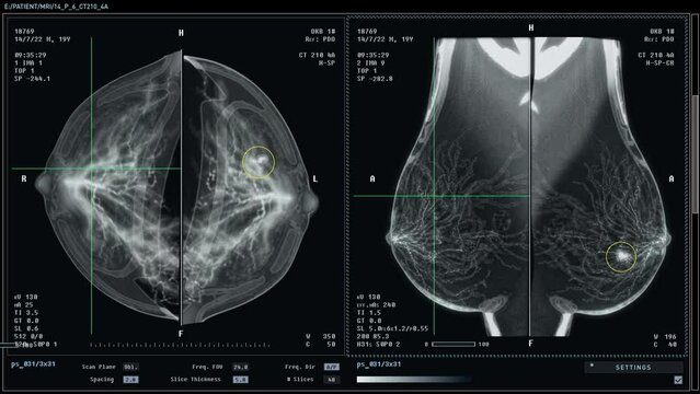 Screening checkup detecting the cancer growth in the woman's patient chest. Medical screening check up identifies the cancer cells in the breast. Screening checkup diagnoses the first stage of cancer.