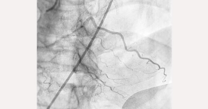 Cardiac catheterization showing coronary arteries  used to diagnose and treat some heart conditions.