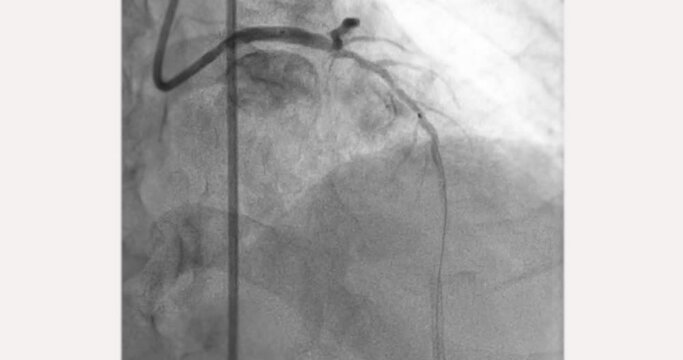 Cardiac catheterization showing coronary arteries  used to diagnose and treat some heart conditions.