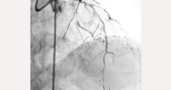 Cardiac catheterization showing coronary arteries  used to diagnose and treat some heart conditions.