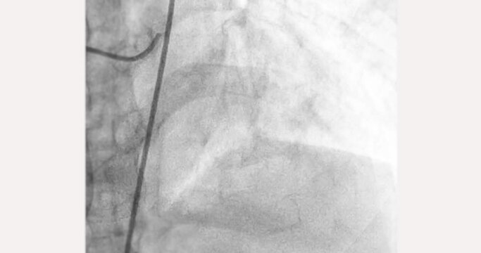 Cardiac catheterization showing coronary arteries  used to diagnose and treat some heart conditions.