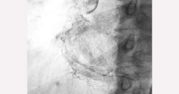 Cardiac catheterization showing coronary arteries  used to diagnose and treat some heart conditions.