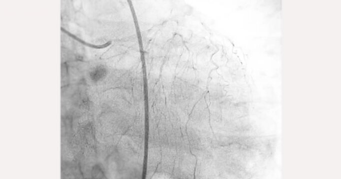 Cardiac catheterization showing coronary arteries  used to diagnose and treat some heart conditions.